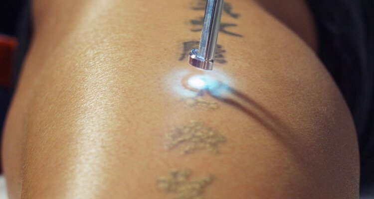 10 Reasons Everyone Want to Remove a Tattoo 10 reasons everyone want to remove a tattoo